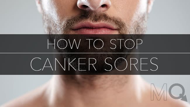How to Stop Canker Sores - Change These 3 Things!